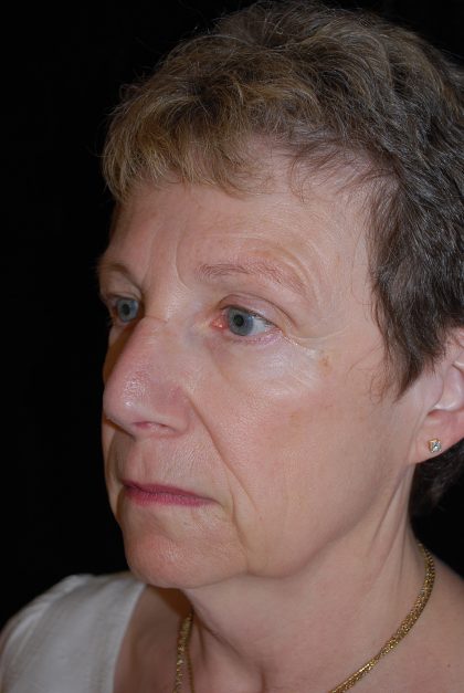 Facelift Before & After Patient #14860