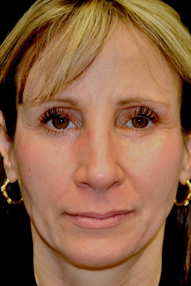 Fat Transfer to Face Before & After Patient #14946