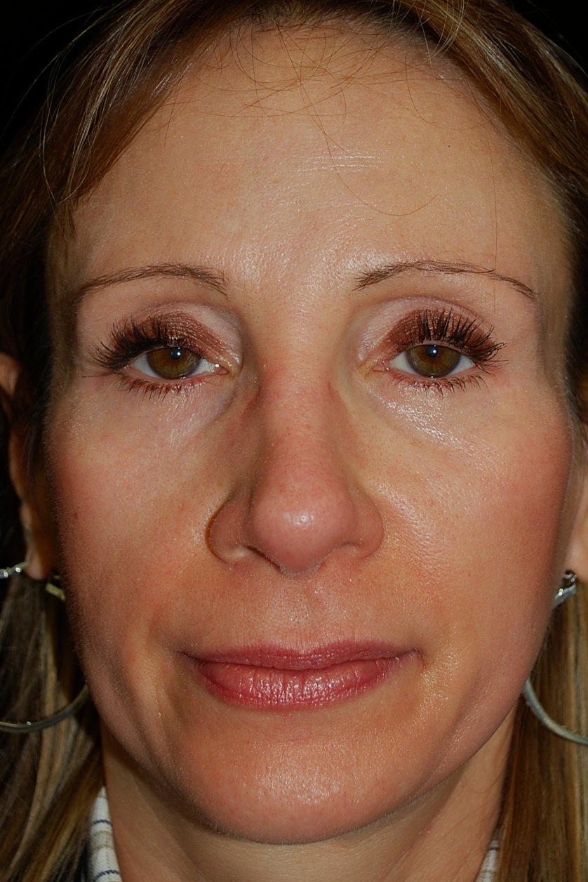 Fat Transfer to Face Before & After Patient #14946