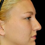 Rhinoplasty Before & After Patient #15207