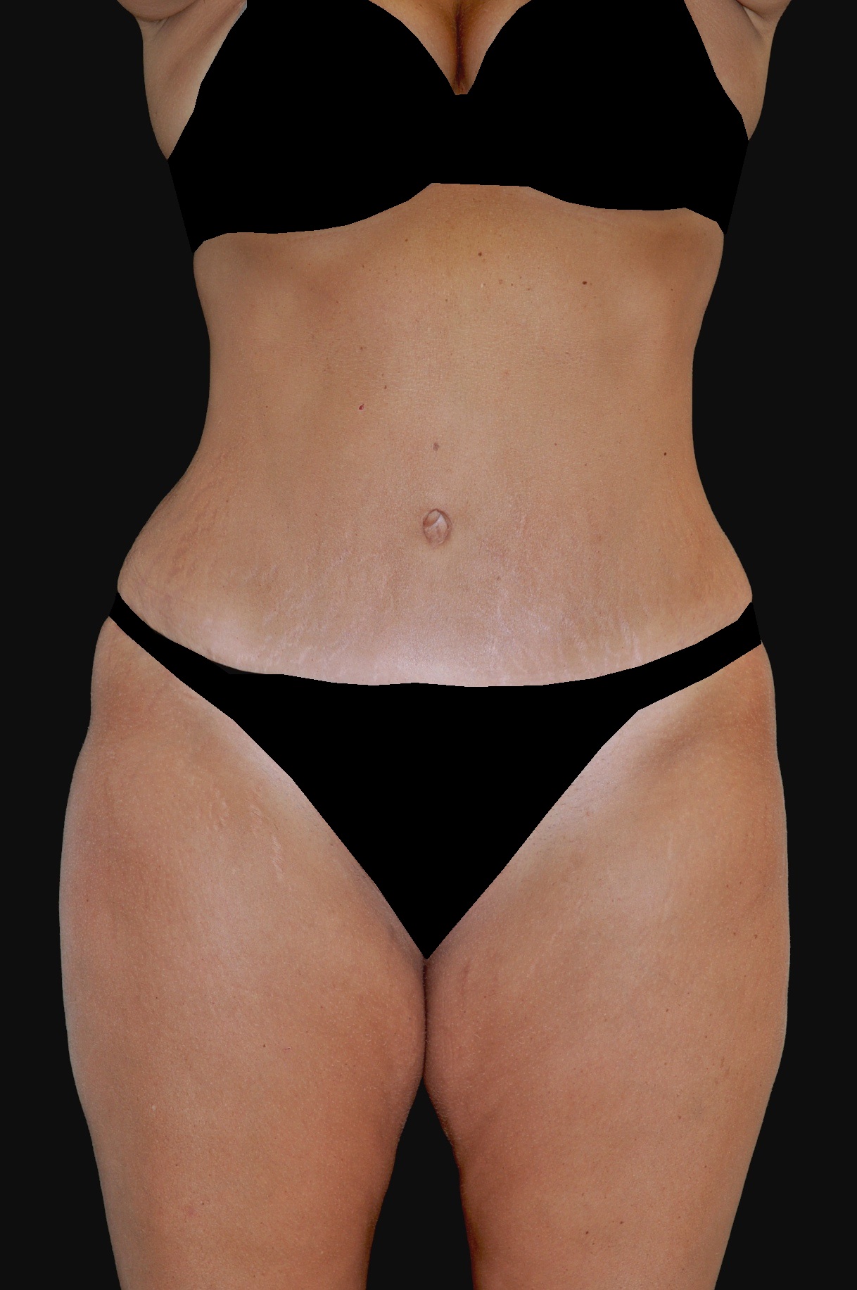 Lipoabdominoplasty Before & After Patient #15146