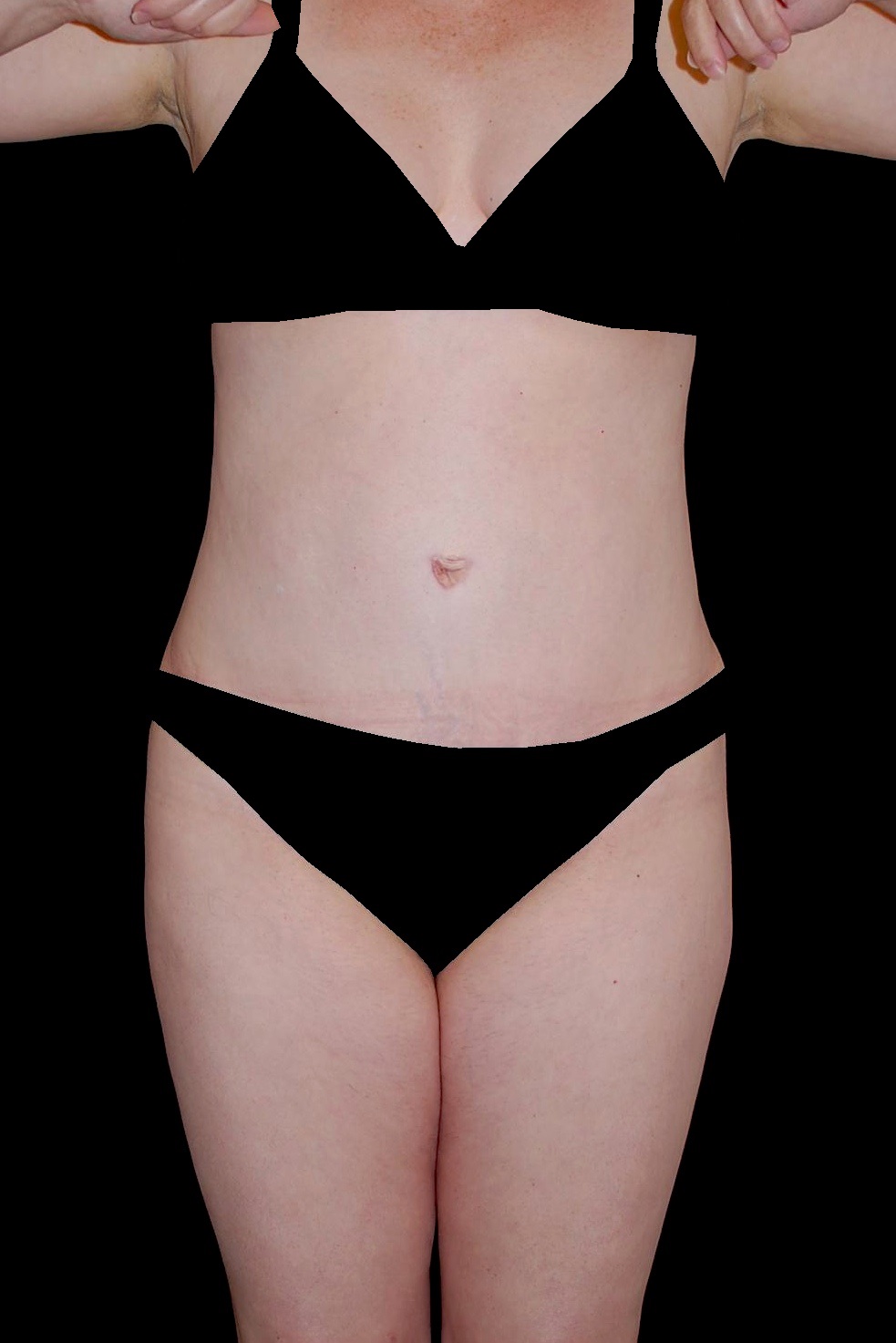 Tummy Tuck Before & After Patient #15184