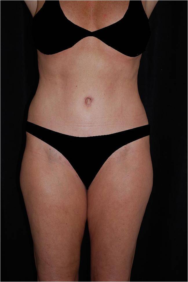 Lipoabdominoplasty Before & After Patient #15167