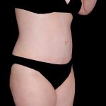 Tummy Tuck Before & After Patient #15184