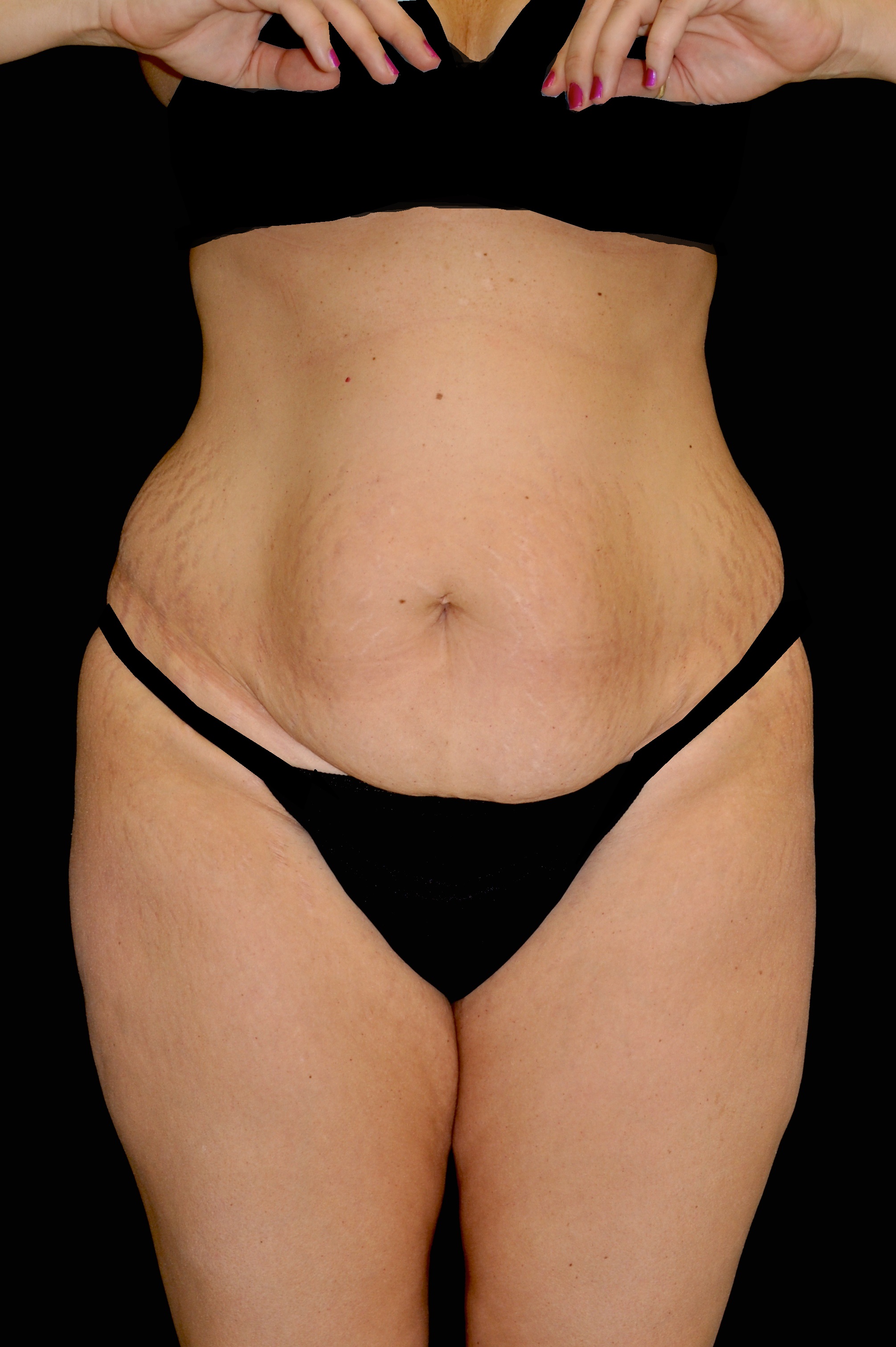 Lipoabdominoplasty Before & After Patient #15146