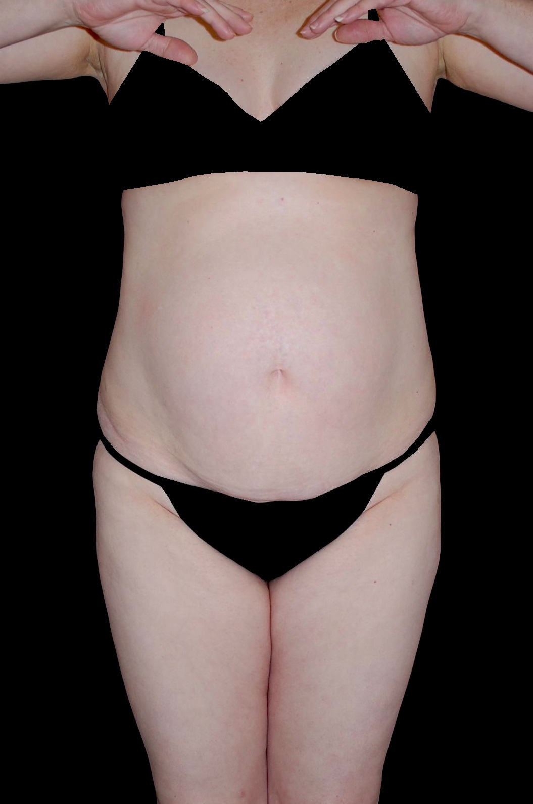 Tummy Tuck Before & After Patient #15184
