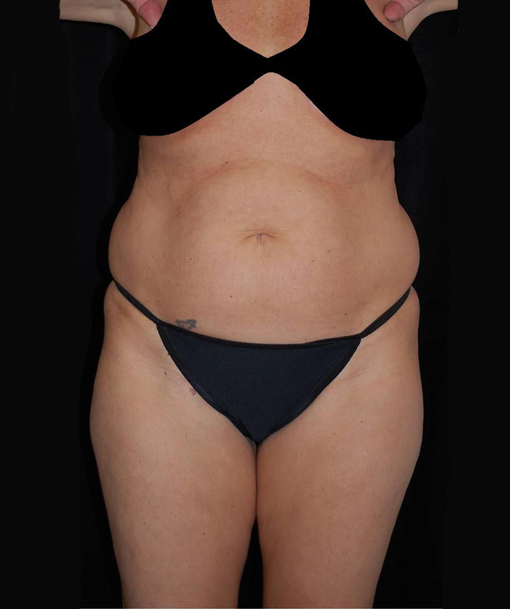 Lipoabdominoplasty Before & After Patient #15167