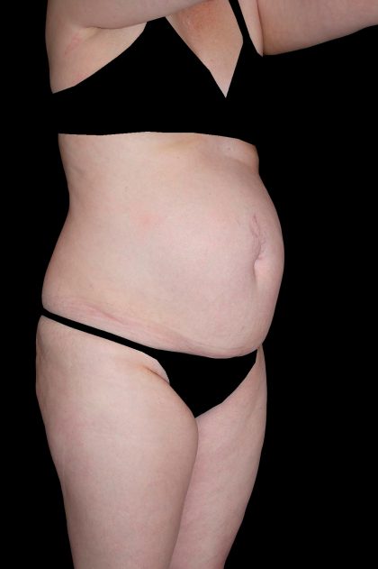 Tummy Tuck Before & After Patient #15184