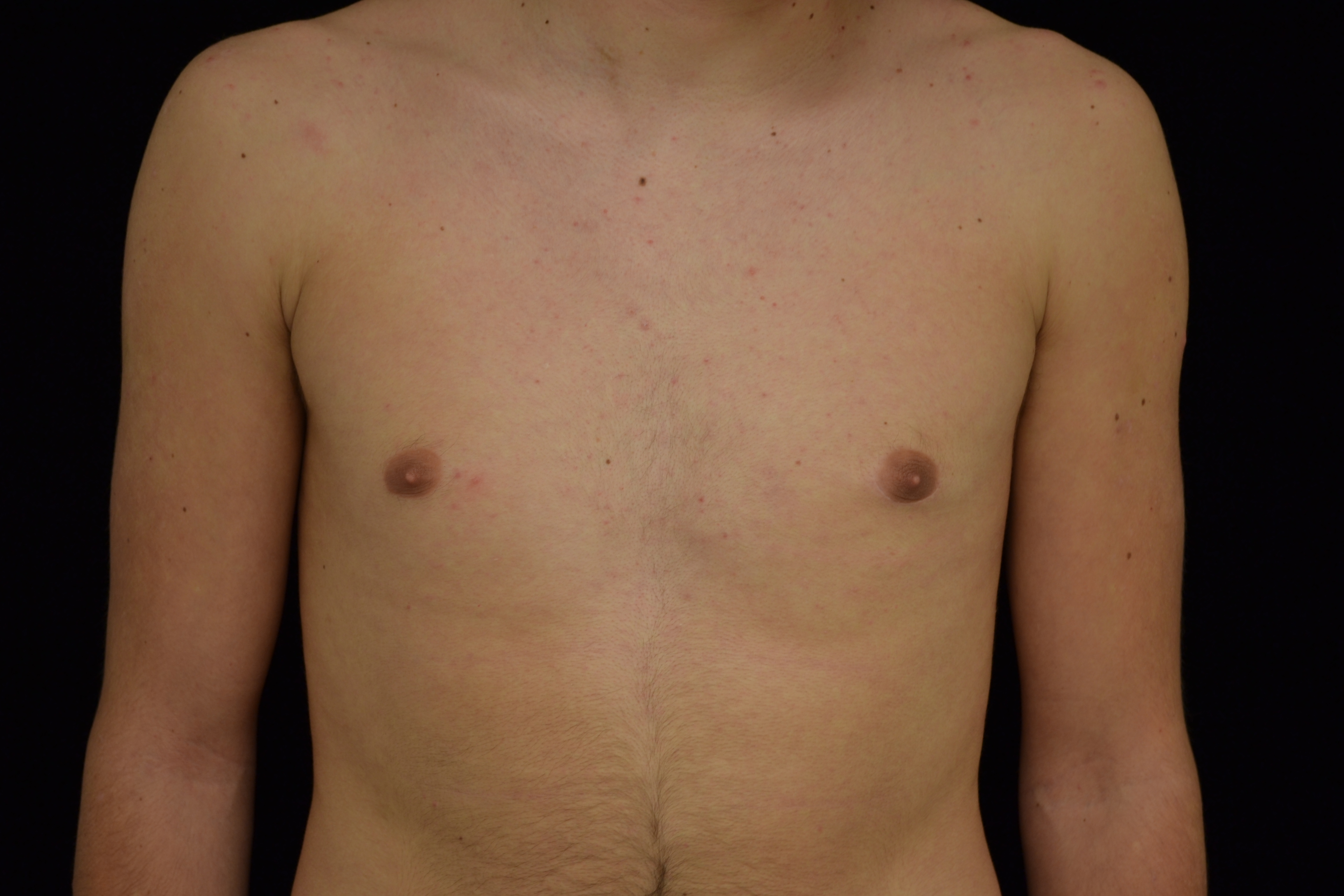 Gynecomastia Before & After Patient #14956