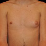 Gynecomastia Before & After Patient #14956
