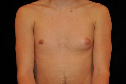 Gynecomastia Before & After Patient #14956