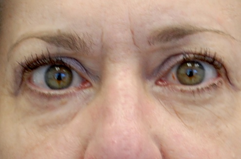 Blepharoplasty Before & After Patient #13902