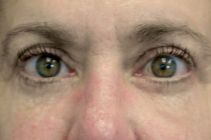 Blepharoplasty Before & After Patient #13902