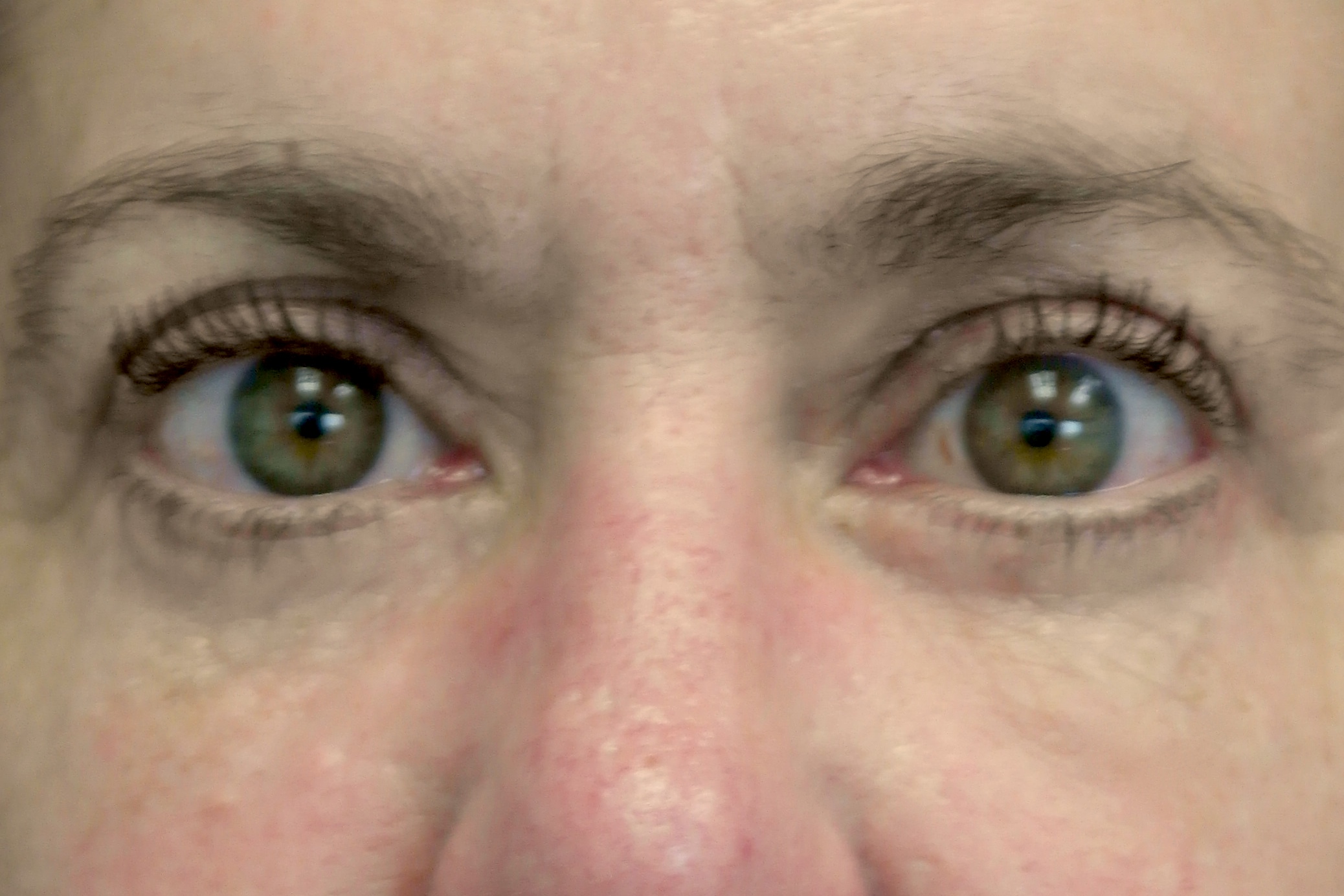 Blepharoplasty Before & After Patient #13902