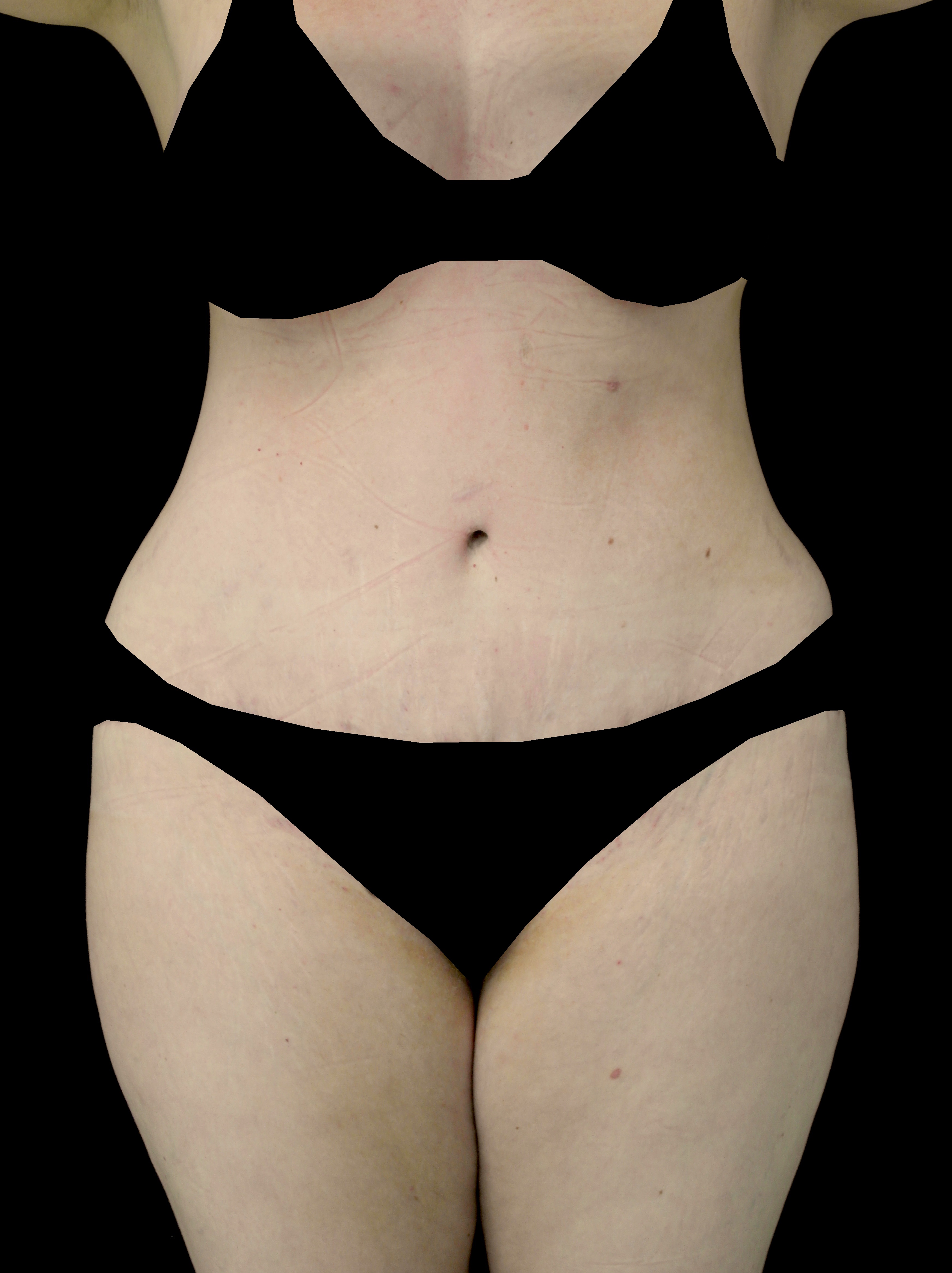 Mommy Makeover Before & After Patient #15308