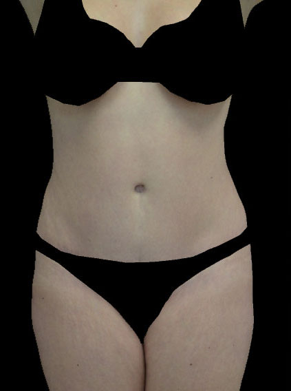 Tummy Tuck Before & After Patient #14940