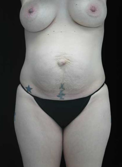 Tummy Tuck Before & After Patient #14992