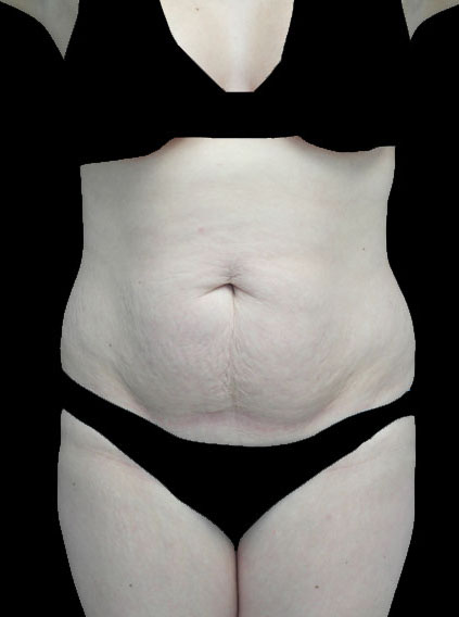 Tummy Tuck Before & After Patient #14940