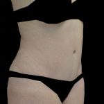 Tummy Tuck Before & After Patient #14940
