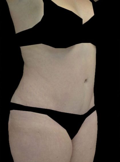 Tummy Tuck Before & After Patient #14940
