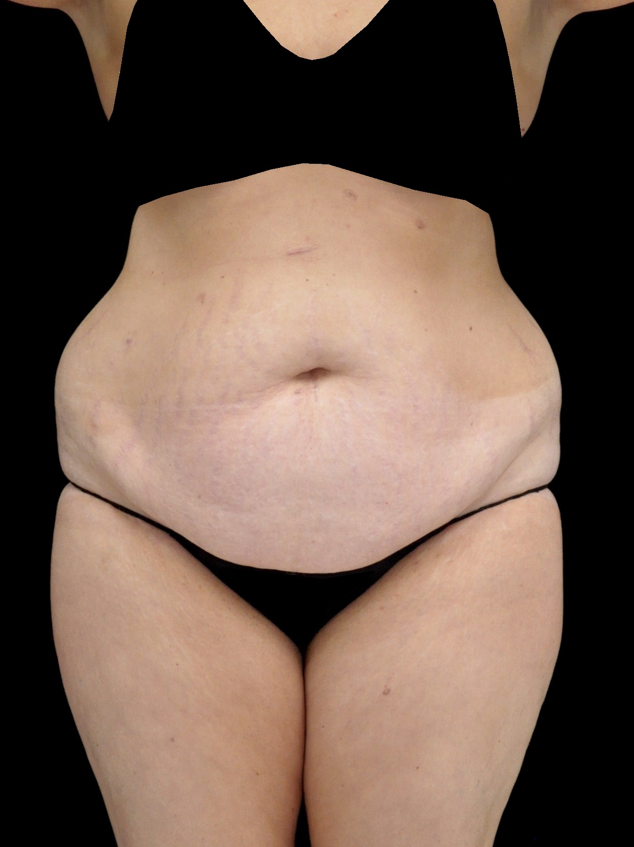 Mommy Makeover Before & After Patient #15308