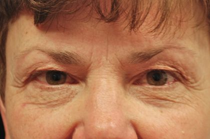 Blepharoplasty Before & After Patient #13889