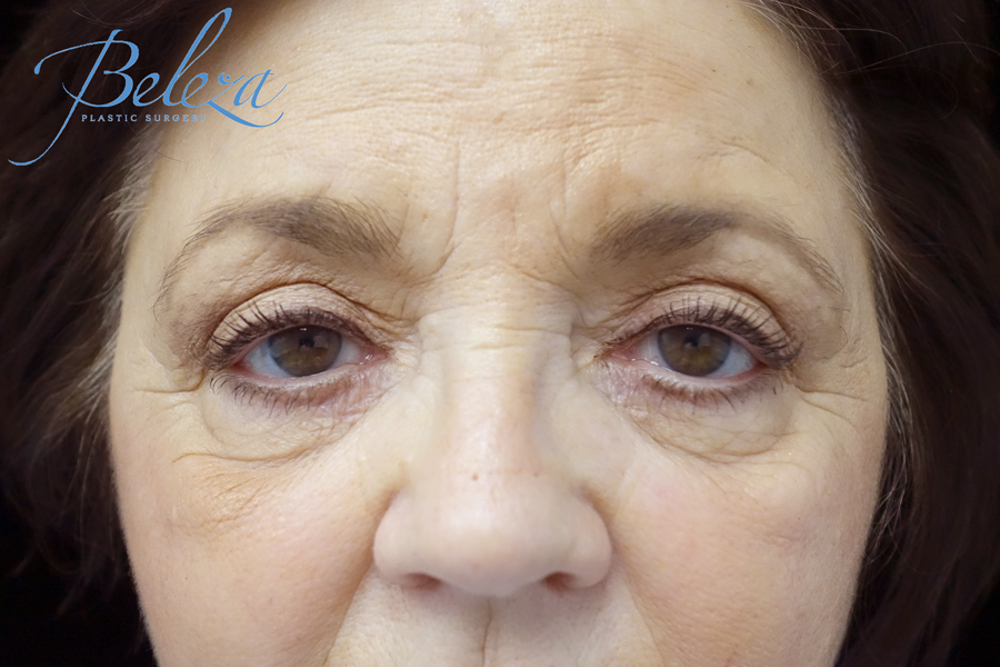 Blepharoplasty Before & After Patient #13876