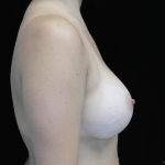 Breast Augmentation (Implants) Before & After Patient #14090
