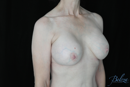 Breast Revision Before & After Patient #14656