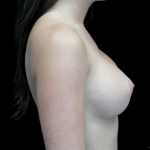Breast Augmentation (Implants) Before & After Patient #14311