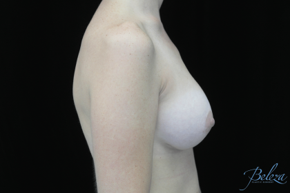Breast Augmentation (Implants) Before & After Patient #14318