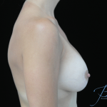 Breast Lift with Implants Before & After Patient #14485