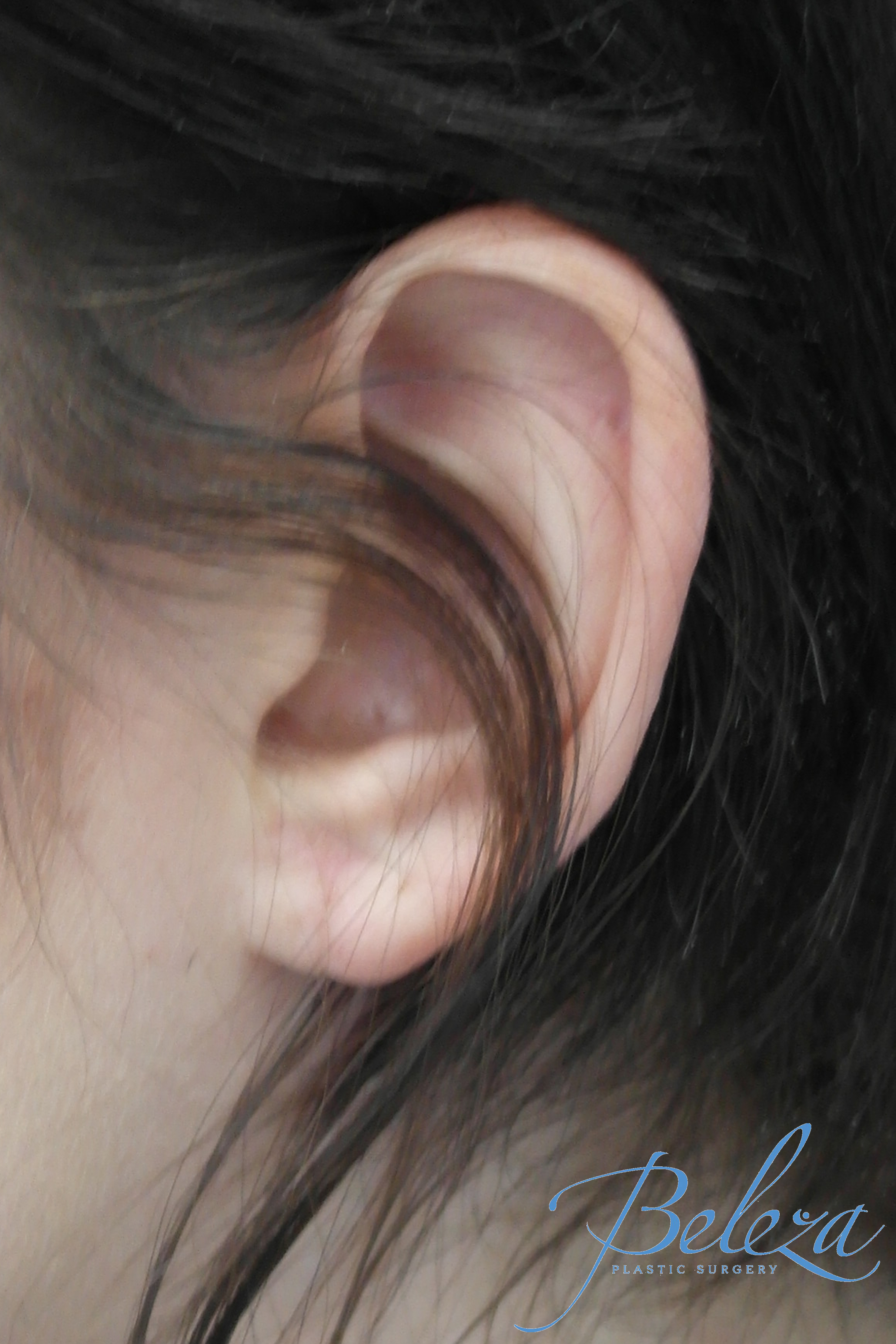 Earlobe Repair Before & After Patient #14827