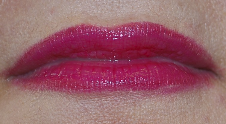 Lip Augmentation - Fillers Before & After Patient #14873