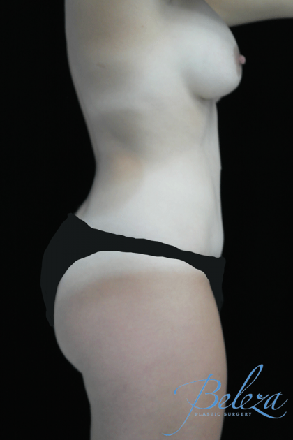 Mommy Makeover Before & After Patient #15260