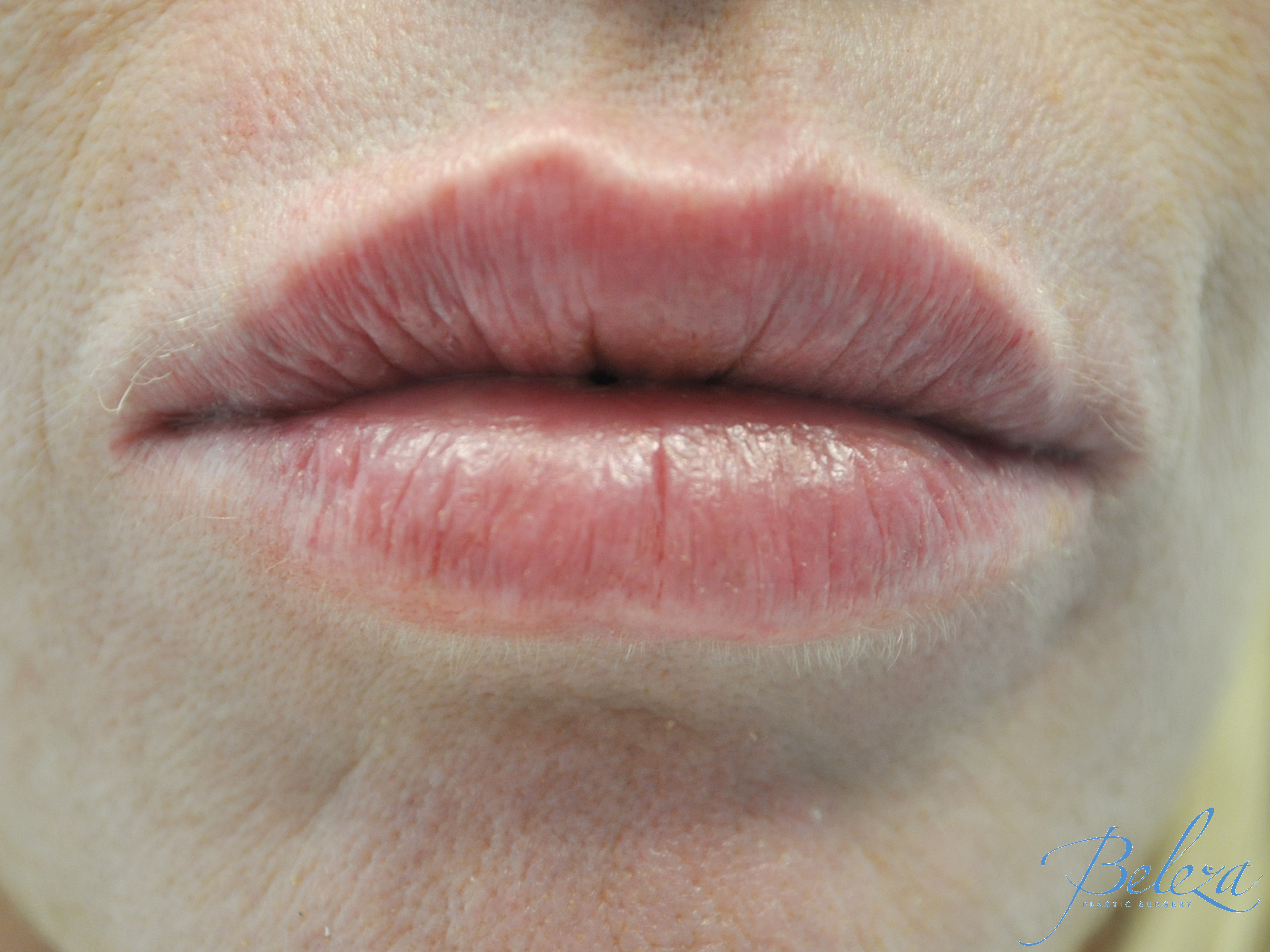 Lip Augmentation - Fillers Before & After Patient #14852