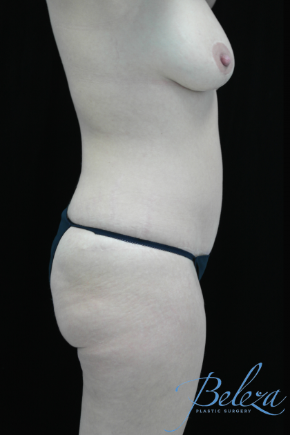 Mommy Makeover Before & After Patient #15281