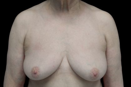 Breast Augmentation (Implants) Before & After Patient #14231