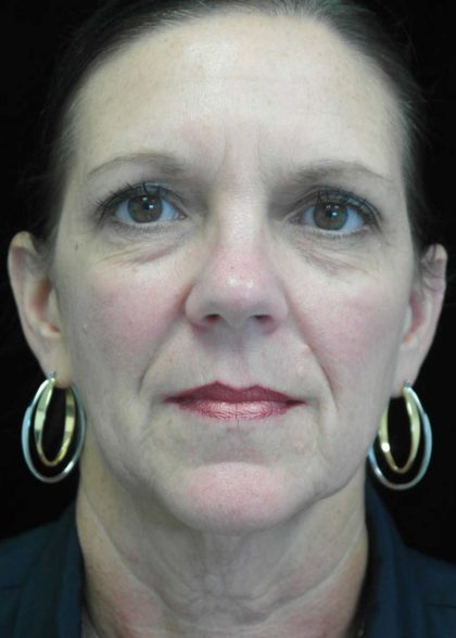 Facelift Before & After Patient #14876