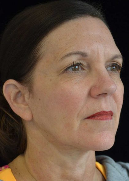 Facelift Before & After Patient #14876