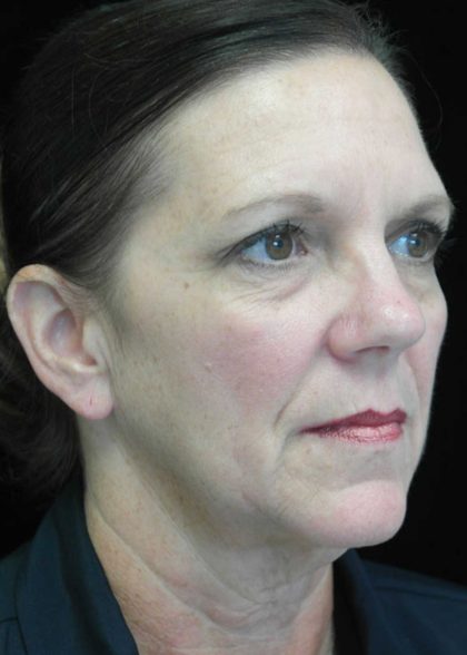 Facelift Before & After Patient #14876