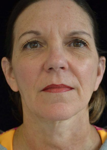 Facelift Before & After Patient #14876