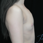 Breast Augmentation (Implants) Before & After Patient #14325