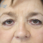 Blepharoplasty Before & After Patient #13876