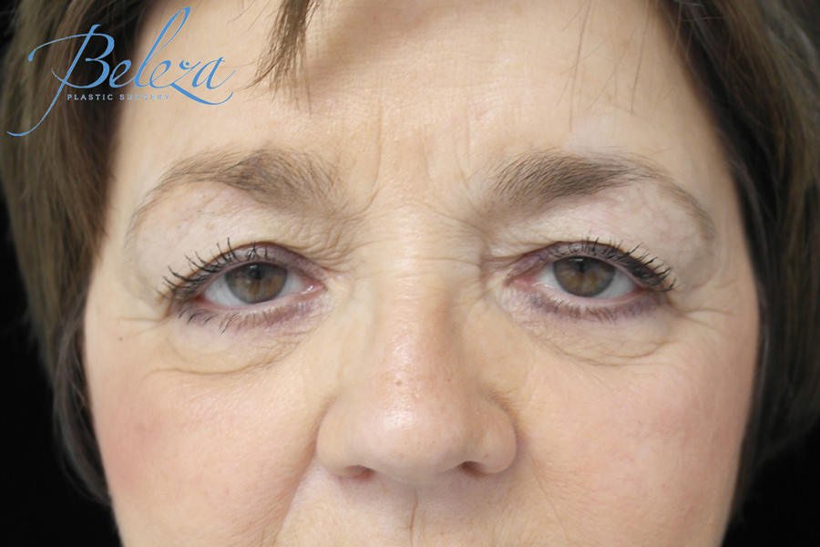 Blepharoplasty Before & After Patient #13876