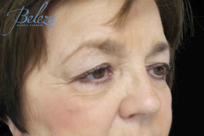 Blepharoplasty Before & After Patient #13876