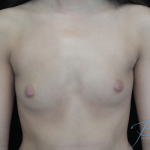 Breast Augmentation (Implants) Before & After Patient #14325