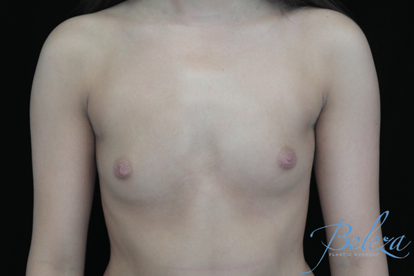 Breast Augmentation (Implants) Before & After Patient #14325