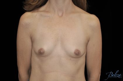 Breast Augmentation (Implants) Before & After Patient #14318