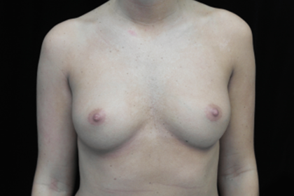 Breast Augmentation (Implants) Before & After Patient #14311
